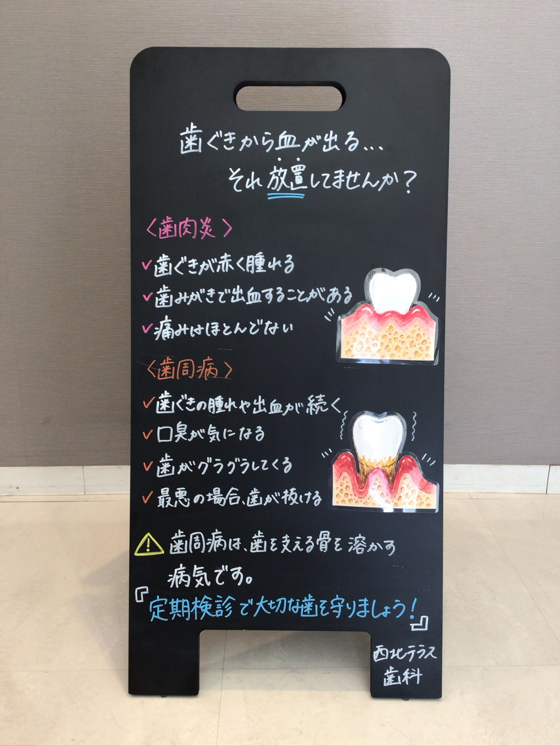 🩸歯みがきのたびに血が出ていませんか？